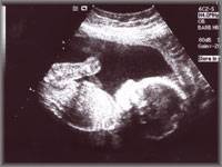 ultrasound image of unborn child