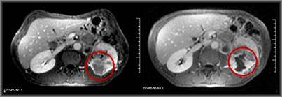 before and after images of a destroyed kidney tumour using high intensity ultrasound